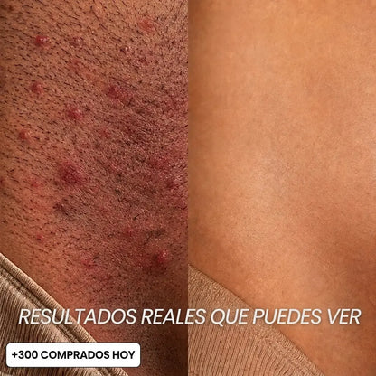 Aceite Anti-Vello · Inhibidor de Crecimiento
